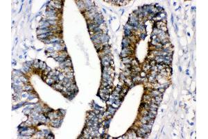 Anti- MAOA Picoband antibody,IHC(P) IHC(P): Human Intestinal Cancer Tissue
