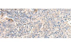 Immunohistochemistry of paraffin-embedded Human cervical cancer tissue using PARS2 Polyclonal Antibody at dilution of 1:30(x200) (PARS2 Antikörper)