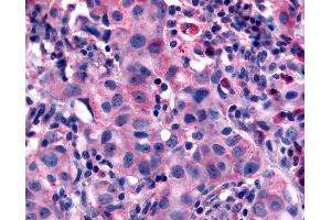 Anti-NANP antibody IHC of human Breast, Carcinoma. (NANP Antikörper  (N-Term))