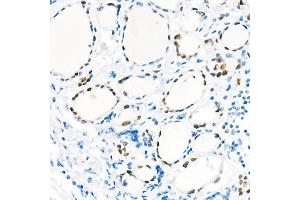 Immunohistochemistry (IHC) image for anti-NK2 Homeobox 1 (NKX2-1) antibody (ABIN1679475)