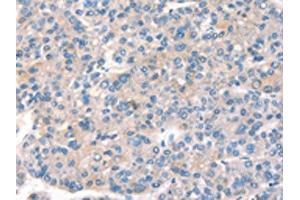 The image on the left is immunohistochemistry of paraffin-embedded Human liver cancer tissue using ABIN7191162(KCNB1 Antibody) at dilution 1/40, on the right is treated with synthetic peptide. (Kv2.1/KCNB1 Antikörper)