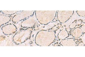 Immunohistochemistry of paraffin-embedded Human thyroid cancer tissue using TCAP Polyclonal Antibody at dilution of 1:55(x200) (TCAP Antikörper)
