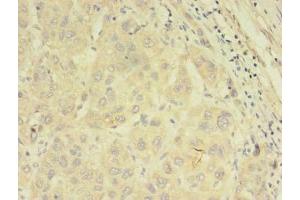 Immunohistochemistry of paraffin-embedded human liver cancer using ABIN7144889 at dilution of 1:100 (ABCB5 Antikörper  (AA 547-760))