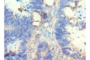 Immunohistochemistry of paraffin-embedded human ovarian cancer using ABIN7162566 at dilution of 1:100 (AMY2A Antikörper  (AA 242-511))