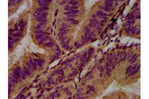 IHC image of ABIN7143399 diluted at 1:400 and staining in paraffin-embedded human endometrial cancer performed on a Leica BondTM system. (Adhesion G Protein-Coupled Receptor G1 (ADGRG1) (AA 26-216) Antikörper)