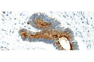 Immunohistochemistry of paraffin-embedded Human colorectal cancer using WWOX Polyclonal Antibody at dilution of 1/20