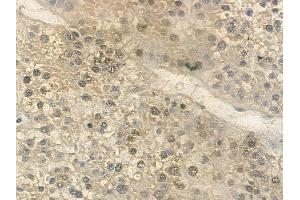 ABIN6261812 and ABIN6268892 at 1/100 staining human hepatocellular carcinoma by IHC-P. (FOSL2 Antikörper  (C-Term))