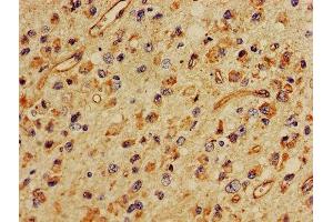 IHC image of ABIN7160401 diluted at 1:400 and staining in paraffin-embedded human glioma performed on a Leica BondTM system. (MBP Antikörper  (AA 1-197))