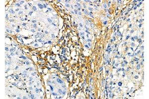 ABIN6265941 and ABIN6272458 at 1/100 staining Human pancreatic cancer by IHC-P. (Vomeronasal 1 Receptor 3 (VMN1R3) (Internal Region) Antikörper)