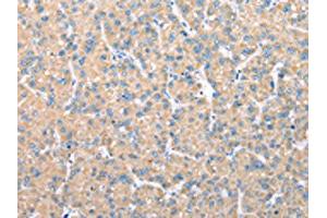 The image on the left is immunohistochemistry of paraffin-embedded Human liver cancer tissue using ABIN7128073(VAPA Antibody) at dilution 1/30, on the right is treated with fusion protein. (VAPA Antikörper)