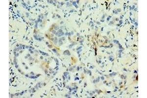 Immunohistochemistry of paraffin-embedded human lung cancer using ABIN7159272 at dilution of 1:100 (MAGEA6 Antikörper  (AA 75-314))