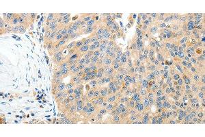 Immunohistochemistry of paraffin-embedded Human ovarian cancer tissue using RAMP3 Polyclonal Antibody at dilution 1:40