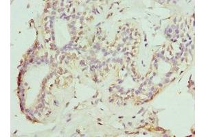 Immunohistochemistry of paraffin-embedded human breast cancer using ABIN7161014 at dilution of 1:100