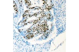 Immunohistochemical analysis of HCFC1 staining in human colon cancer formalin fixed paraffin embedded tissue section. (HCFC1 Antikörper  (N-Term))