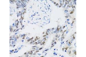 Immunohistochemistry of paraffin-embedded Human colon carcinoma using CDK6 Polyclonal Antibody at dilution of 1:100 (40x lens). (CDK6 Antikörper)