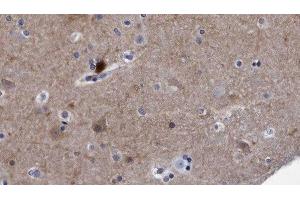 ABIN6278497 at 1/100 staining Human brain cancer tissue by IHC-P. (Reticulon 4 Antikörper  (Internal Region))