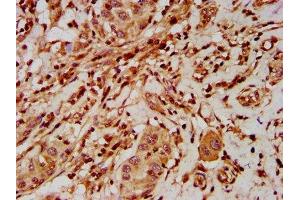 IHC image of ABIN7151576 diluted at 1:500 and staining in paraffin-embedded human liver cancer performed on a Leica BondTM system. (ELP2 Antikörper  (AA 323-457))