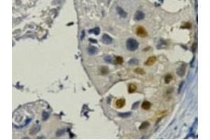 Immunohistochemistry (IHC) staining of Human Breast cancer tissue paraffin-embedded, diluted at 1:200. (PCNA Antikörper)