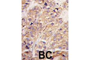 Formalin-fixed and paraffin-embedded human breast carcinoma tissue reacted with SMURF1 polyclonal antibody  , which was peroxidase-conjugated to the secondary antibody, followed by DAB staining.