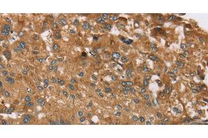 Immunohistochemistry of paraffin-embedded Human liver cancer tissue using RPS6KA2 Polyclonal Antibody at dilution 1:40 (RPS6KA2 Antikörper)