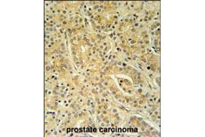 UBAC1 Antibody immunohistochemistry analysis in formalin fixed and paraffin embedded human prostate carcinoma followed by peroxidase conjugation of the secondary antibody and DAB staining.