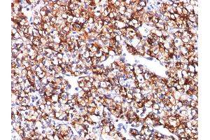 Formalin-fixed, paraffin-embedded human Renal Cell Carcinoma stained with CAIX Mouse Monoclonal Antibody (CA9/781). (CA9 Antikörper)