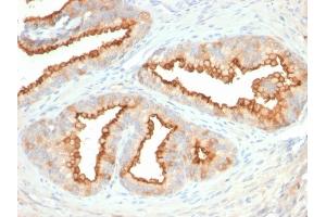 Formalin-fixed, paraffin-embedded human Prostate Carcinoma stained with CD10 Mouse Monoclonal Antibody (MME/2579). (MME Antikörper  (AA 583-740))