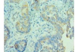 Immunohistochemistry of paraffin-embedded human lung cancer using ABIN7158946 at dilution of 1:100 (MDH2 Antikörper  (AA 59-338))