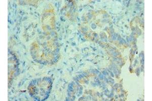 Immunohistochemistry of paraffin-embedded human lung cancer using ABIN7158946 at dilution of 1:100 (MDH2 Antikörper  (AA 59-338))