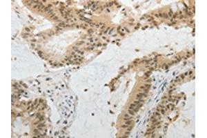The image on the left is immunohistochemistry of paraffin-embedded Human colon cancer tissue using ABIN7130225(MGEA5 Antibody) at dilution 1/20, on the right is treated with fusion protein. (MGEA5 Antikörper)