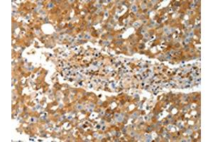 The image on the left is immunohistochemistry of paraffin-embedded Human breast cancer tissue using (TEP1 Antibody) at dilution 1/40, on the right is treated with synthetic peptide. (TEP1 Antikörper)
