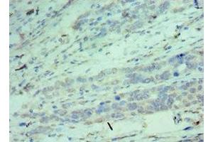Immunohistochemistry of paraffin-embedded human endometrial cancer using ABIN7148906 at dilution of 1:100 (CDK9 Antikörper  (AA 153-372))