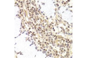 Immunohistochemistry of paraffin-embedded human adenomyosis using PHC1 antibody (ABIN5973455) at dilution of 1/200 (40x lens). (PHC1 Antikörper)