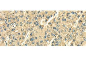 Immunohistochemistry of paraffin-embedded Human liver cancer tissue using SDF4 Polyclonal Antibody at dilution 1:35 (SDF4 Antikörper)