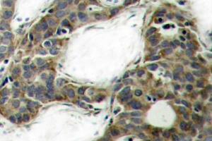 Immunohistochemistry (IHC) analyzes of Catenin-beta antibody in paraffin-embedded human breast carcinoma tissue. (CTNNB1 Antikörper)