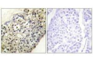Immunohistochemistry analysis of paraffin-embedded human breast carcinoma tissue, using LATH antibody. (BPIFA4P Antikörper)