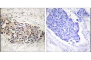 Immunohistochemistry analysis of paraffin-embedded human breast carcinoma tissue, using USF2 Antibody. (USF2 Antikörper  (AA 196-245))