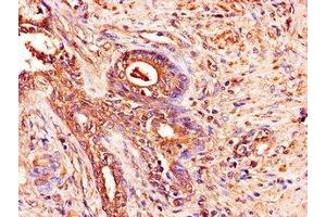 Immunohistochemistry of paraffin-embedded human prostate cancer using ABIN7150038 at dilution of 1:100 (ADAM12 Antikörper  (AA 730-909))