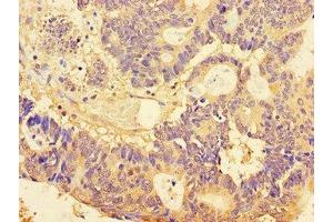 Immunohistochemistry of paraffin-embedded human colon cancer using ABIN7160076 at dilution of 1:100 (BUB3 Antikörper  (AA 6-217))