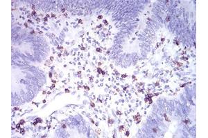 Immunohistochemical analysis of paraffin-embedded rectum cancer tissues using CD2 mouse mAb with DAB staining. (CD2 Antikörper  (AA 25-140))