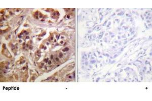 Immunohistochemistry analysis of paraffin-embedded human breast carcinoma tissue using GRLF1 polyclonal antibody .