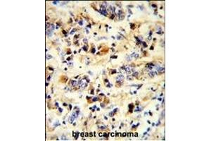 Formalin-fixed and paraffin-embedded human breast carcinoma reacted with EGFR Antibody, which was peroxidase-conjugated to the secondary antibody, followed by DAB staining. (EGFR Antikörper)