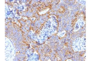 Formalin-fixed, paraffin-embedded human Colon stained with CEA Mouse Monoclonal Antibody (C66/1291). (CEACAM5 Antikörper)
