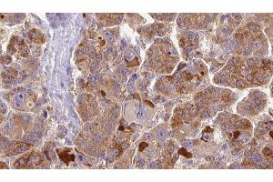 ABIN6273855 at 1/100 staining Human liver cancer tissue by IHC-P. (GPR146 Antikörper  (Internal Region))