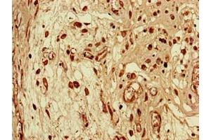 Immunohistochemistry of paraffin-embedded human lung cancer using ABIN7168651 at dilution of 1:100 (SEC14L3 Antikörper  (AA 201-400))