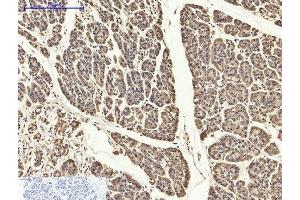 Immunohistochemistry of paraffin-embedded Human stomach cancer tissue using PYCARD Polyclonal Antibody at dilution of 1:200. (PYCARD Antikörper)