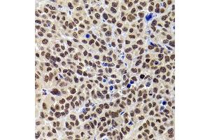 Immunohistochemistry of paraffin-embedded human kidney cancer using PHIP antibody at dilution of 1:100 (40x lens). (PHIP Antikörper)