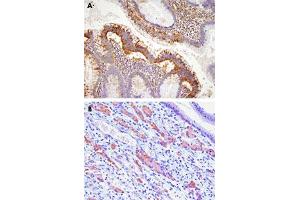 Paraffin embedded sections of human colon (A) and gastric cancer tissue (B) were incubated with EPHA2 monoclonal antibody, clone 3D7  (1:100) for 2 hours at room temperature. (EPH Receptor A2 Antikörper  (AA 559-976))