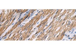 Immunohistochemistry of paraffin-embedded Human gastric cancer tissue using KCNH7 Polyclonal Antibody at dilution of 1:30(x200) (KCNH7 Antikörper)