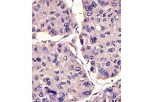(ABIN6242256 and ABIN6578832) staining CANX in human hepatocarcinoma sections by Immunohistochemistry (IHC-P - paraformaldehyde-fixed, paraffin-embedded sections). (Calnexin Antikörper  (AA 560-592))